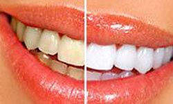 Picture of a smiling woman showing unwhitened teeth on one side of the smile and whitened teeth on the other side.