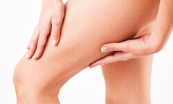 Close-up picture of a woman with her hands on her thighs illustrating the results of a thigh lift she had.