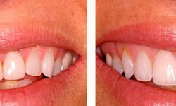 Before and after pictures of a smiling patient showing new veneers on the top teeth.