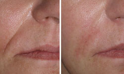 Close-up picture of a female face showing the results of a wrinkle fillers procedure.