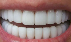 Picture of before and after upper and lower teeth showing the results of a zirconium crowns procedure.