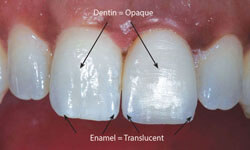 Picture of 5 teeth including the two front teeth with Zirconium veneers