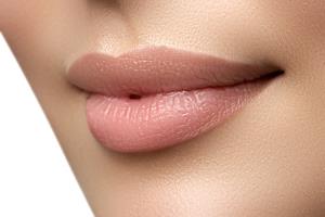 Close-up picture of woman’s face showing the lip fillers procedure she had in Costa Rica.