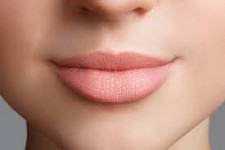 Close-up picture of a woman’s lips showing her lip augmentation procedure she had in Costa Rica.