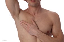 Picture of a male chest after having a male breast reduction procedure he had in Costa Rica.