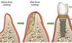 Illustration of a dental bone graft procedure.