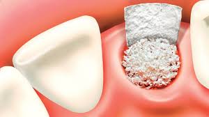 Illustration of a dental bone graft procedure.