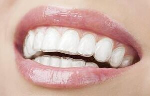 Picture of a smiling woman displaying her braces procedure she had in Costa Rica.