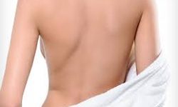 Close-up picture of a woman’s back showing a laser mole removal procedure.