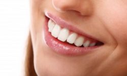 Picture of a smiling woman displaying her dental caps procedure she had in Costa Rica.