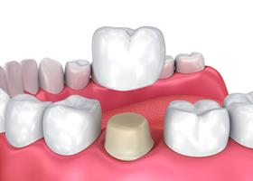 Illustration of a dental caps procedure.