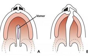Illustration of a cleft lip and palate procedure.