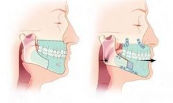 Illustration of a corrective jaw surgery procedure.