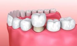 Illustration of a dental crown procedure.