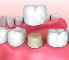Illustration of a dental crown procedure.