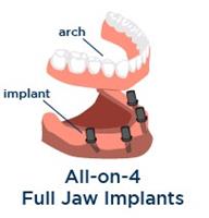 Illustration of an all-on-4 dental implant procedure in Costa Rica