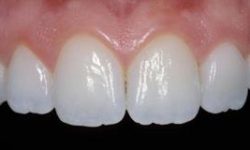 Picture of a smiling woman displaying the top teeth with pure porcelain crowns she had in Costa Rica.