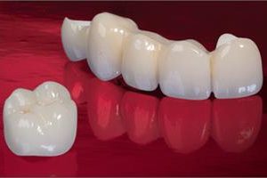 Illustration of a pure porcelain dental crown procedure.