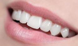 Picture of a smiling woman displaying the top teeth with pure porcelain CEREC crowns she had in Costa Rica.