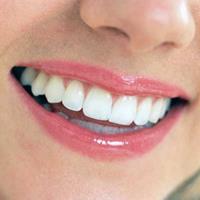 Picture of a smiling woman displaying her top teeth with pure porcelain CEREC crowns she had in Costa Rica.