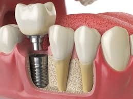 Illustration of a dental implant procedure.