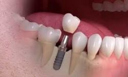 Illustration of a dental implant procedure.