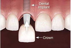 Illustration of a dental implant crown procedure.