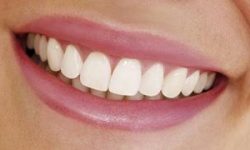 Picture of a smiling woman displaying the dentures procedure she had in Costa Rica.