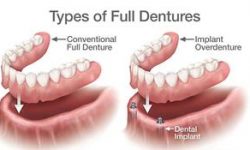 Illustration of an implant-supported dentures procedure.