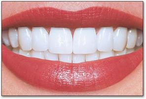 Picture of a smiling woman displaying the implant-supported dentures procedure she had in Costa Rica