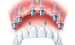 Illustration of an all-on-6 dental implant procedure