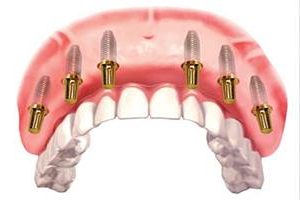 Illustration of an all-on-6 dental implant procedure