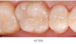 Illustration of a dental fillings procedure.