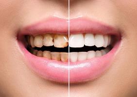 Picture of a smiling woman displaying the full mouth rehabilitation dental procedure she had in Costa Rica.