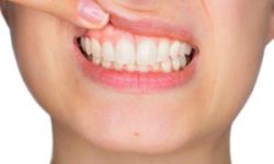 Picture of a woman showing the results of the dental gum surgery procedure she had in Costa Rica.