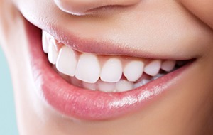 Picture of a woman showing the results of the dental gum surgery procedure she had in Costa Rica.