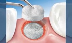 Illustration of a dental bone graft procedure.