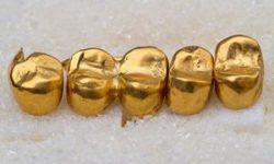 Picture a row of 5 gold filled crowns