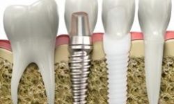 Illustration of a holistic ceramic dental implants procedure.