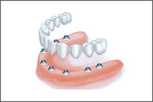 Illustration of an all-on-8 dental implant procedure