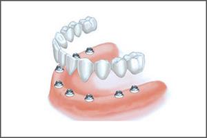 Illustration of an all-on-8 dental implant procedure