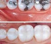 Before and after pictures a row of 4 teeth showing how a holistic fillings removal treatment would look like.