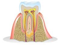 Illustration of an Apicoectomy procedure.