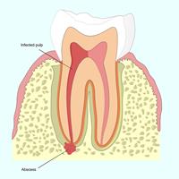 Illustration of an Apicoectomy procedure.