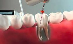 Illustration of a holistic root canal procedure.