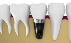 Illustration of a holistic zirconium implants procedure.