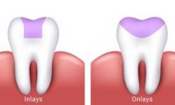 Side by side illustration of a two teeth, one showing a dental inlay procedure and the other showing a dental onlay procedure..