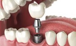 Illustration of a dental implant procedure