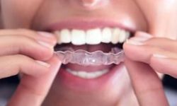 Picture of a smiling woman holding invisible braces to her teeth, showing her happiness with the Invisalign procedure she had in Costa Rica.