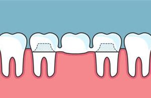 Illustration of a metal porcelain bridge.